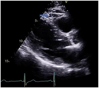 Importance of cardiac imaging assessment of epicardial adipose tissue after a first episode of myocardial infarction